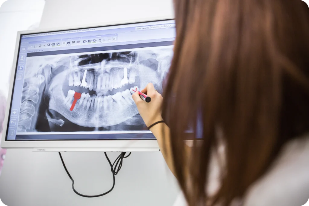 dentiste implant dentaire strasbourg Implant dentaire breining