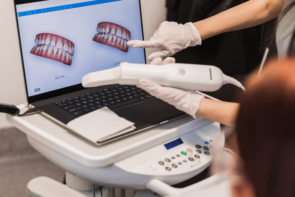 Empreinte numérique au scanner intra-oral, dentiste à Strasbourg