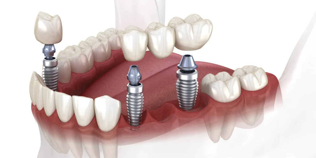 implant dentaire bridge Implants dentaires Mediweb - Template 5